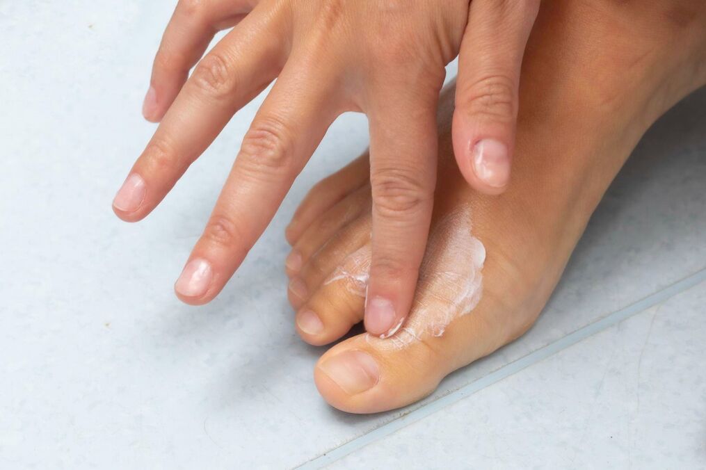 Creme desmyxil do fungo entre os dedos dos pés