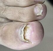 Lançou fungos de unhas