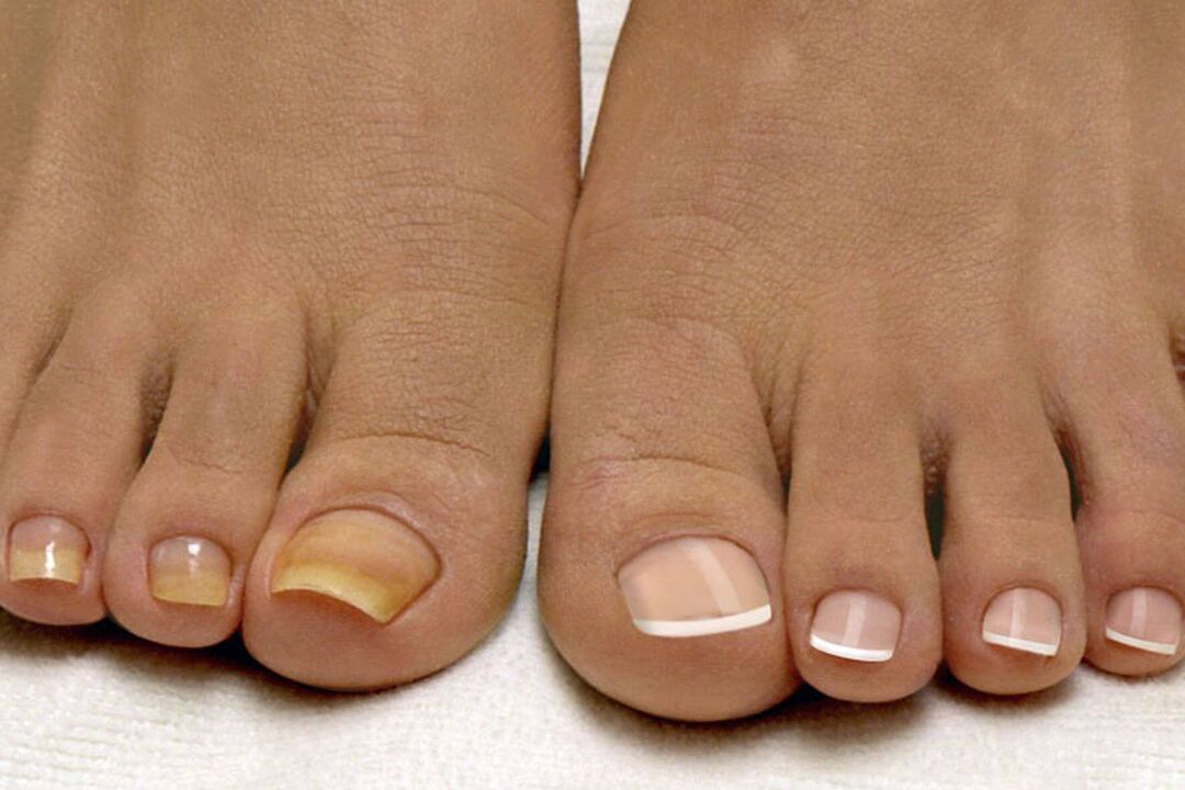 Em uma perna, unhas saudáveis, por outro com um fungo