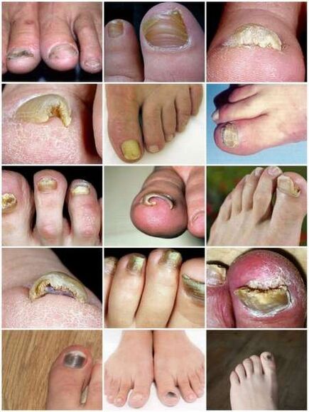 Infecção fúngica da placa ungueal