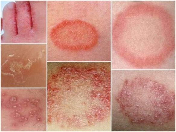 Tricofitose da pele das pernas