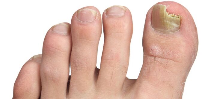 infecção fúngica da lâmina ungueal