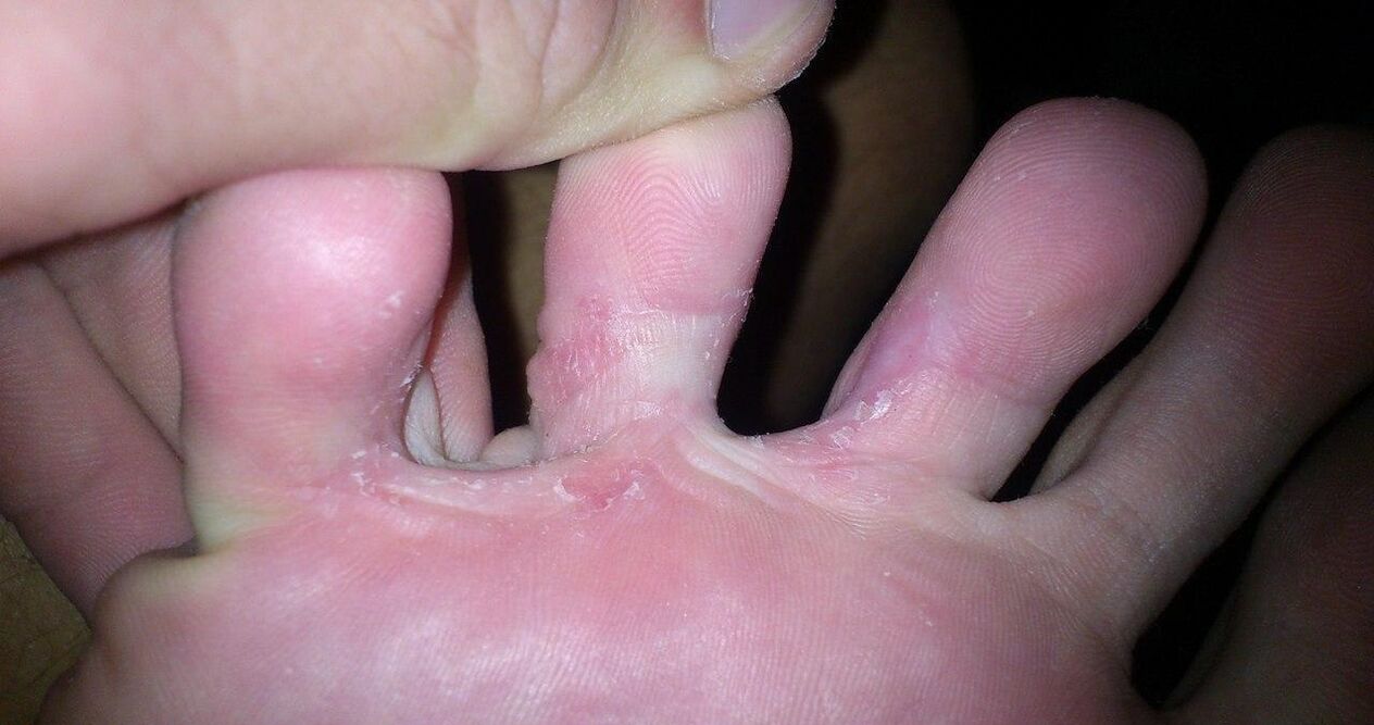 fungo entre os dedos para tratar o creme de desmyxil