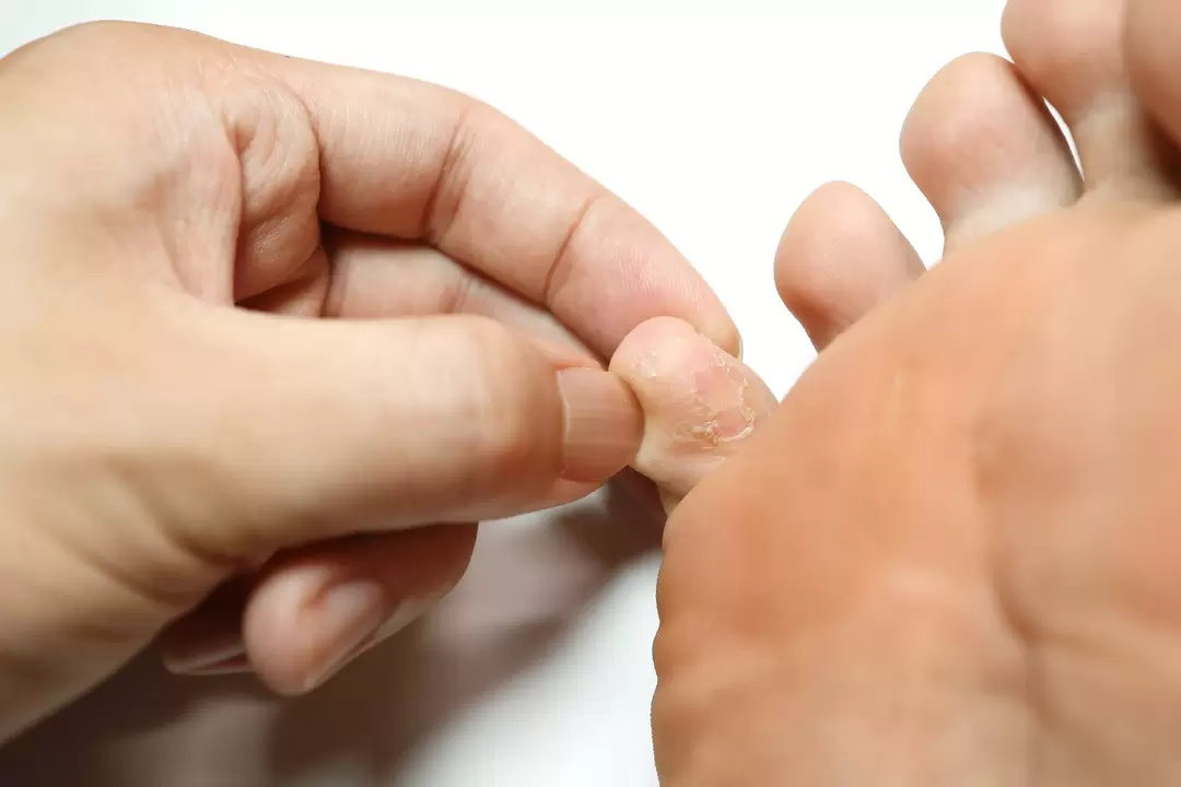 fungo nos dedos e seu tratamento com creme de desmyxil